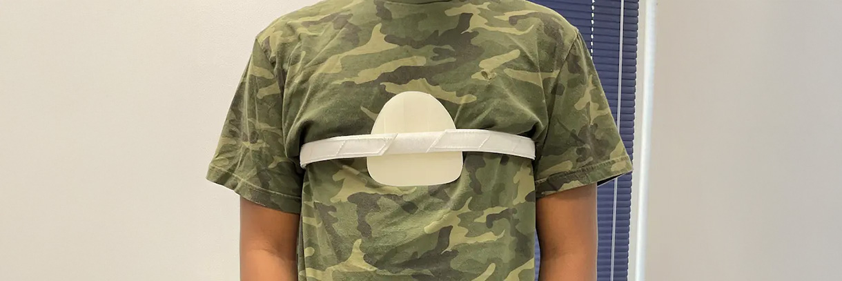 Pectus Carinatum