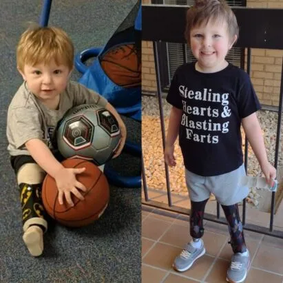 Pediatric Prosthetics