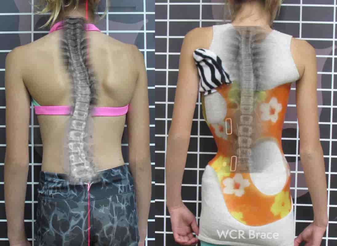 Rigo Cheneau Brace Example