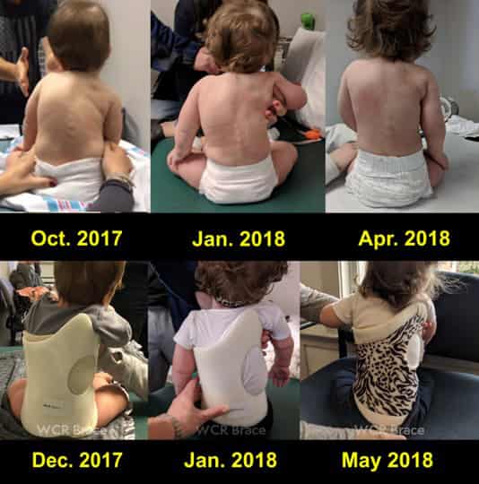 Infant scoliosis treatment progression