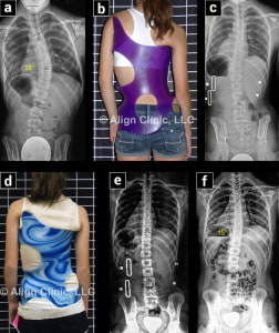 X-ray and Brace