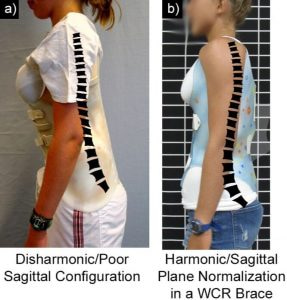 Disharmonic Sagittal Configuration