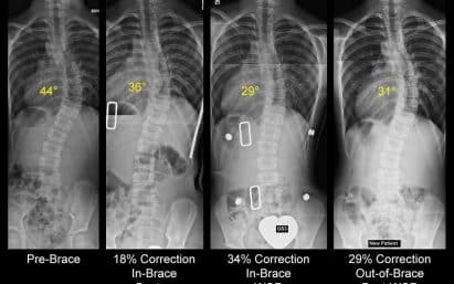X-ray comparison between Boston style and WCR TLSO