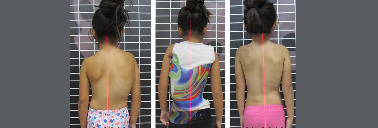Rigo Cheneau Scoliosis Orthosis