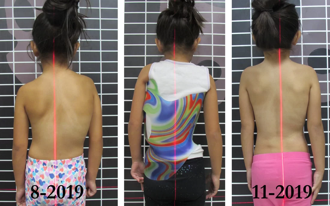Rigo Cheneau Scoliosis Orthosis