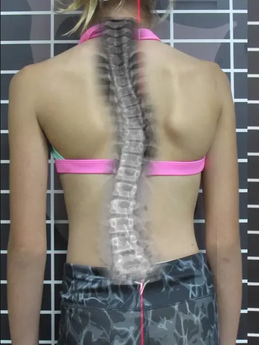 Scoliosis Treatment