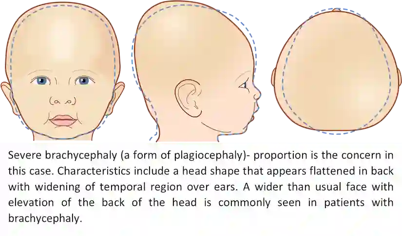 Severe Brachycephaly
