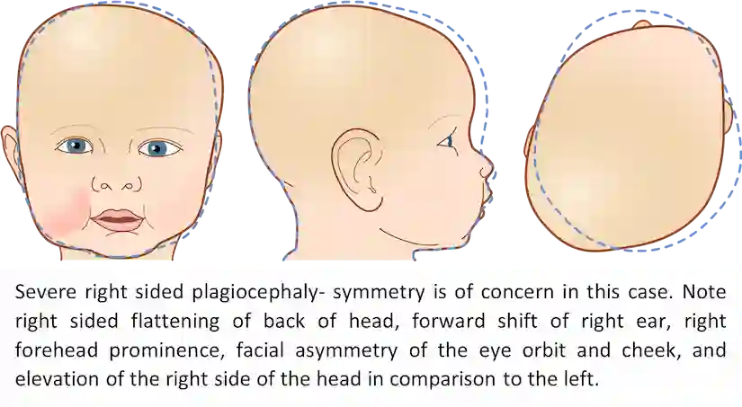Severe Right Sided Plagiocephaly