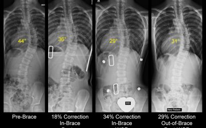 These X rays illustrate a comparison between the Boston style and the WCR. The furthest right picture shows the correction achieved at the end of treatment.