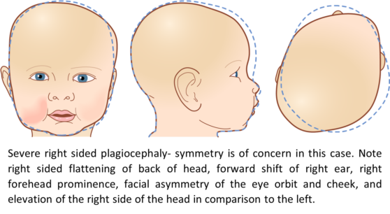 Cranial Remolding - Del Bianco